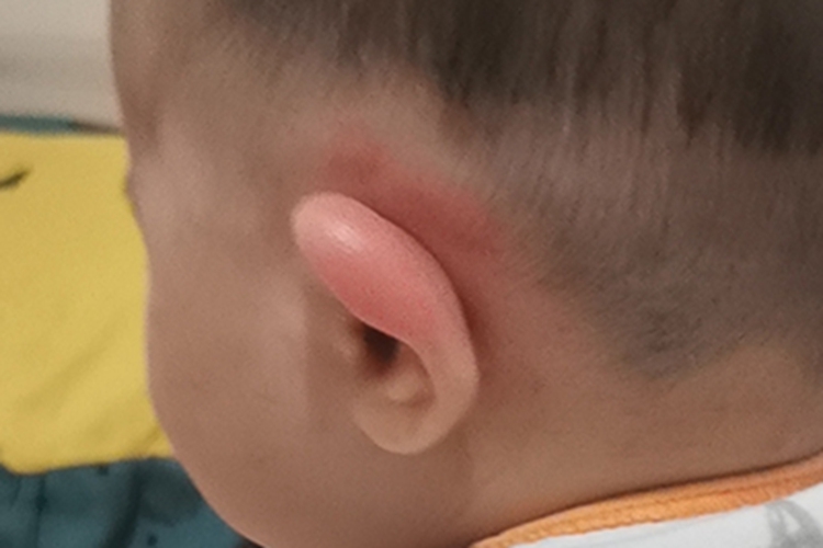 蚊性皮炎耳朵红肿图