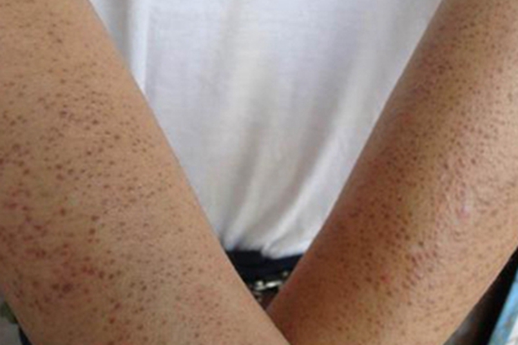 维生素A缺乏症症状图