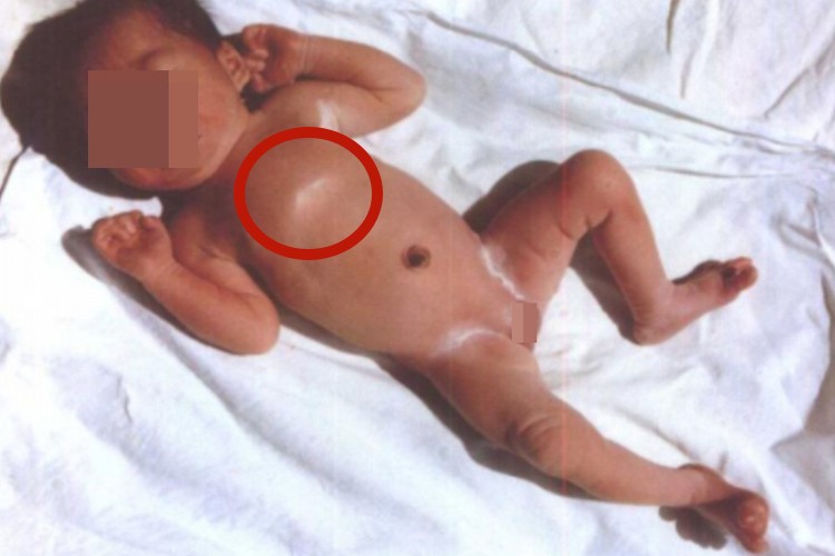 新生儿胸口中间骨头凸起图