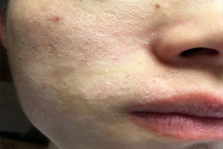 甲状腺功能减退症面部脱屑图