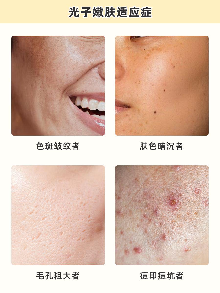 杭州光子嫩肤攻略：从原理到避坑指南