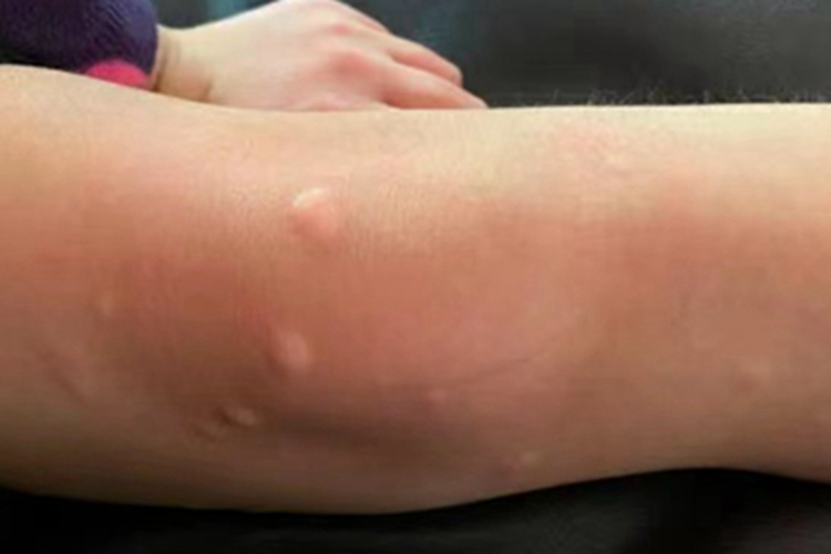 结节型黏液水肿性苔藓结节图 结节型黏液水肿性苔藓结节图