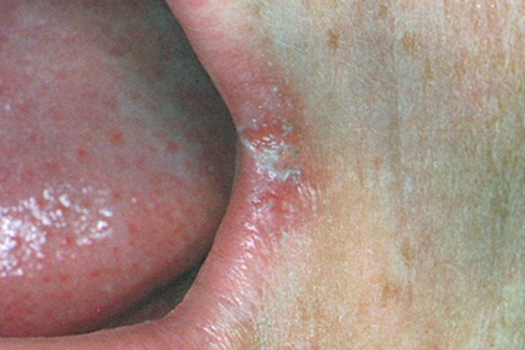 营养不良性口角炎症状图 营养不良性口角炎症状图