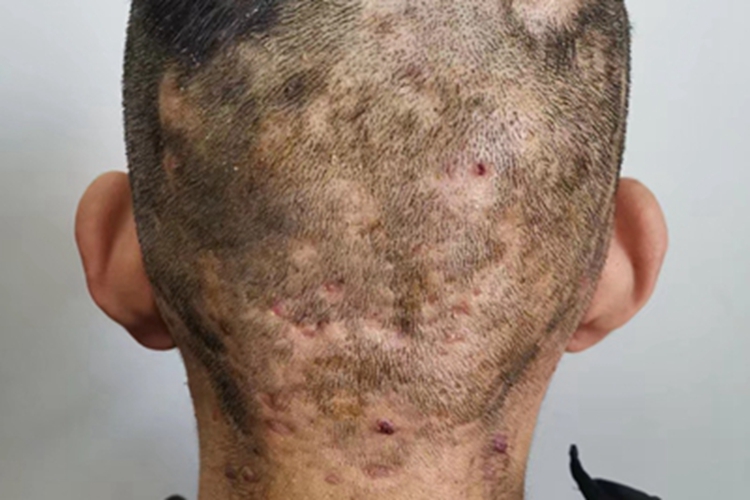 细菌性毛囊炎头皮结痂图 细菌性毛囊炎头皮结痂图