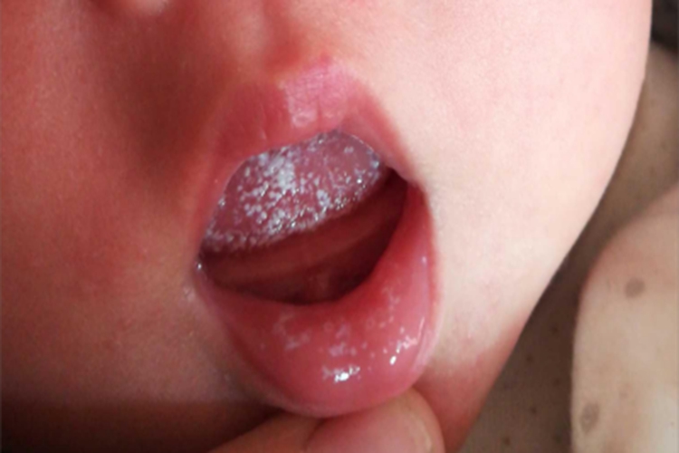 鹅口疮舌头症状图