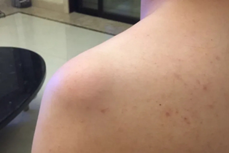 风湿热肩部症状图 风湿热肩部症状图