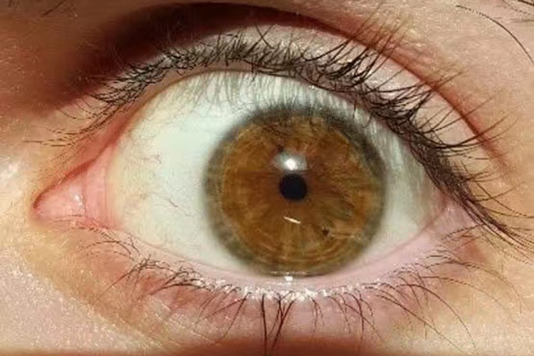 Horner综合征瞳孔缩小图