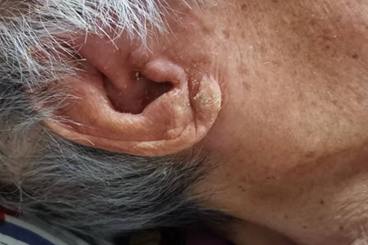 慢性湿疹耳部有黄褐色脱屑图