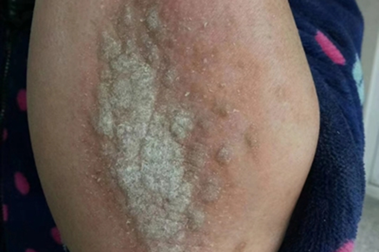 局限性神经性皮炎胳膊疙瘩脱屑图