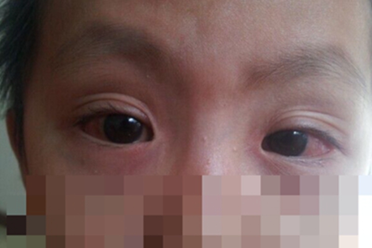 儿童结膜炎充血图