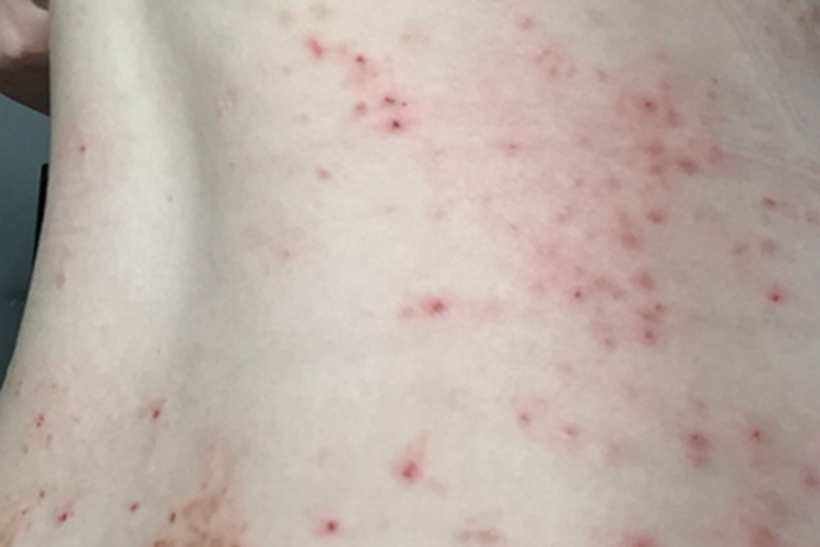成人痒疹小红疙瘩图