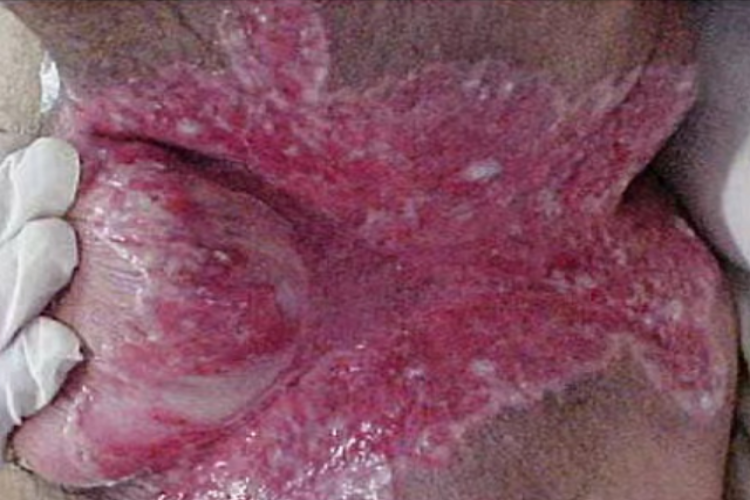 腹股沟肉芽肿大腿根糜烂图