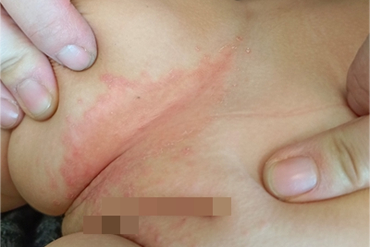 间擦疹大腿症状图