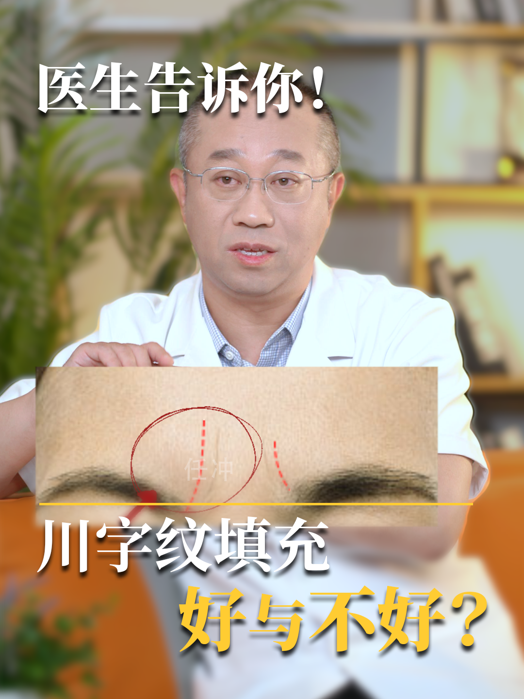 医生告诉你！川字纹填充，好与不好？
