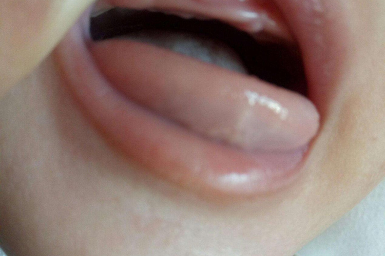 婴儿上牙床标准图