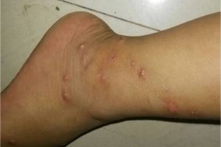 小儿丘疹性肢端皮炎脚踝症状图