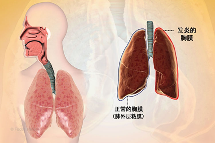 胸膜炎图 胸膜炎图
