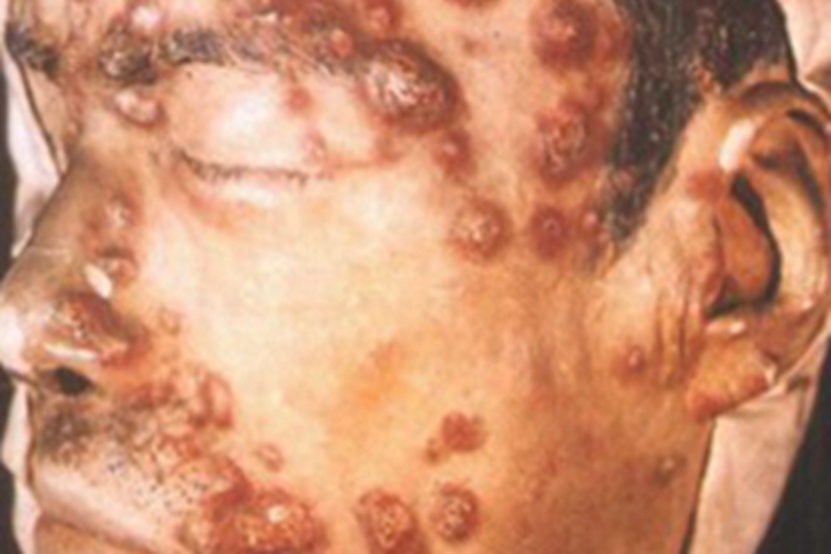 梅毒面部结节图