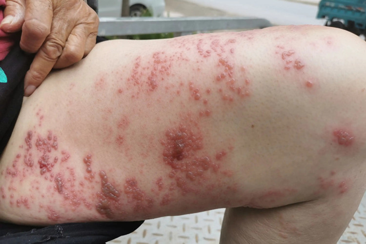 大腿带状疱疹图 大腿带状疱疹图