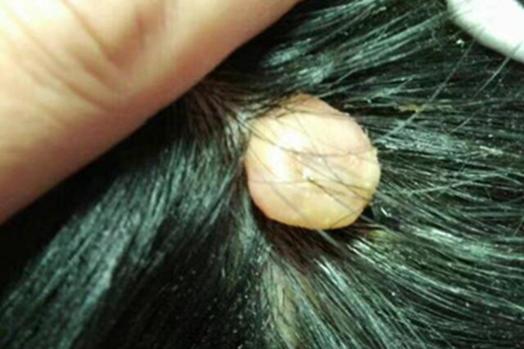 皮肤纤维瘤肉粒图