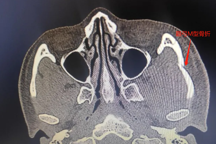 颧弓骨折M型影像图 颧弓骨折M型影像图