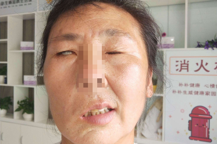 面瘫严重图 面瘫严重图