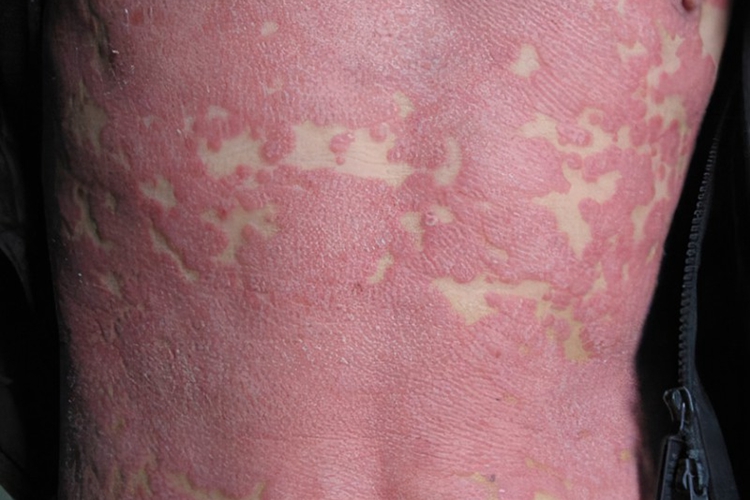 皮排红皮病样皮疹图