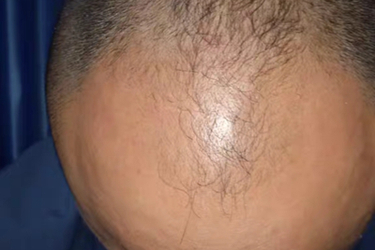 雄激素性脱发前额掉发图 雄激素性脱发前额掉发图