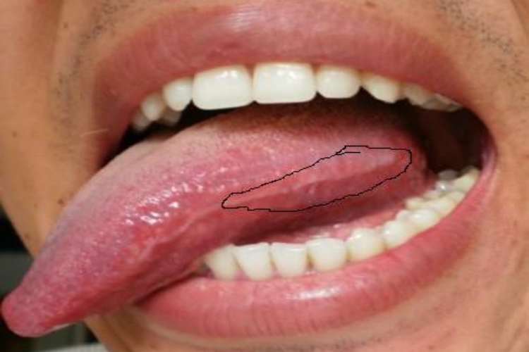 口腔毛状白斑早期图