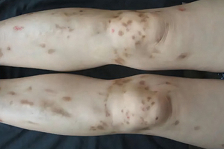 炎症后色素沉着腿症状图 炎症后色素沉着腿症状图