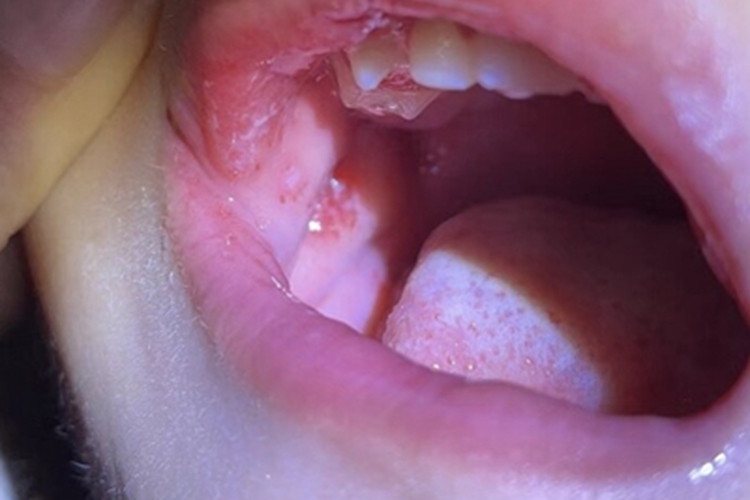 念珠菌性口炎口腔糜烂图