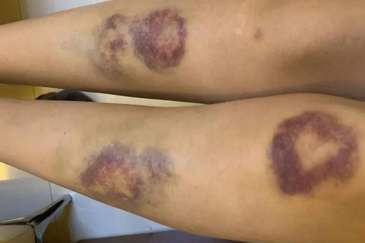 血友病膝关节出血图