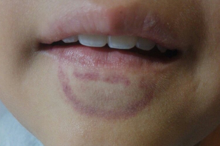 儿童嘴巴周围紫血点图 儿童嘴巴周围紫血点图