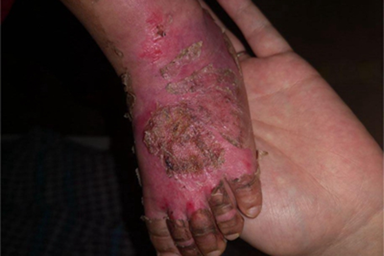二度烫伤脚背结痂图
