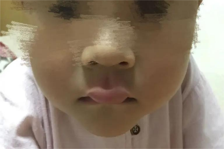 蚊虫叮咬上嘴唇肿图 蚊虫叮咬上嘴唇肿图