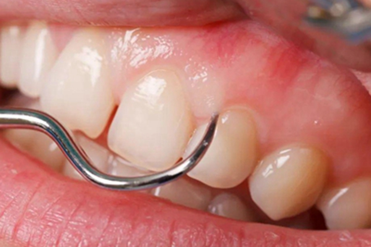 牙龈萎缩牙龈颜色偏白图