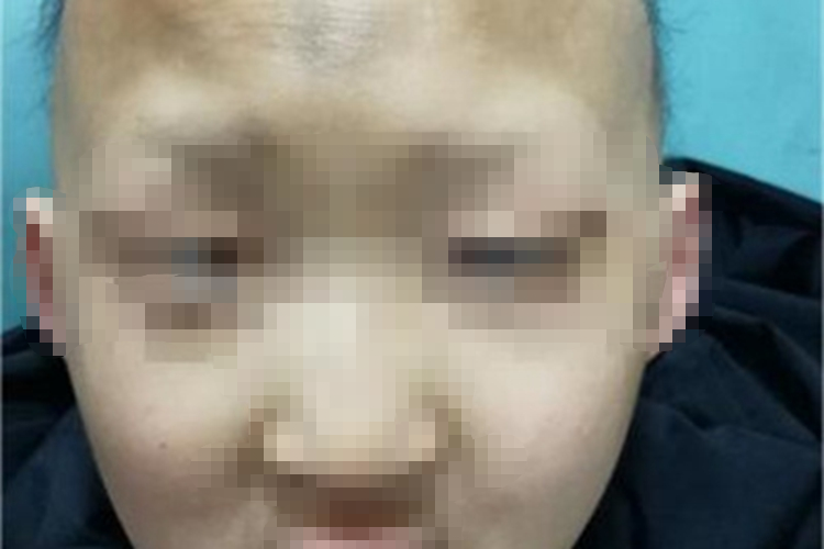 先天性外胚叶发育不良头发稀疏图 先天性外胚叶发育不良头发稀疏图