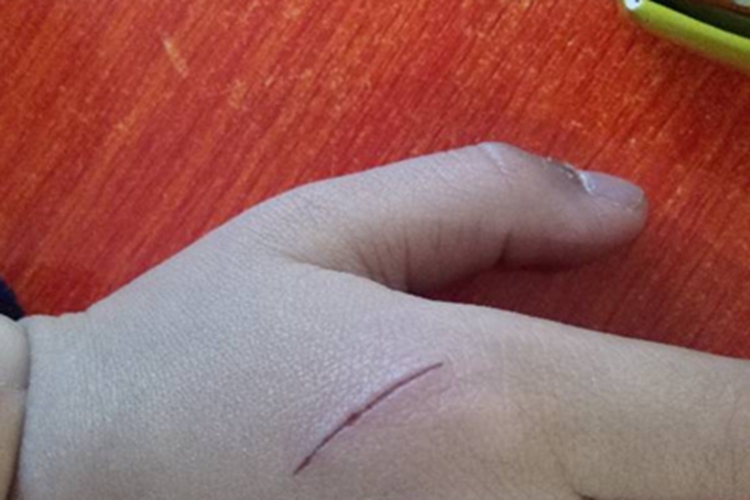 抓伤手背裂纹图