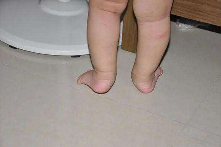 先天性马蹄足外翻图 先天性马蹄足外翻图