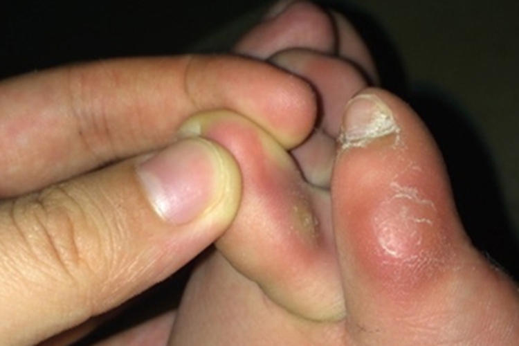 软鸡眼脚趾缝有淡黄色小疙瘩图 软鸡眼脚趾缝有淡黄色小疙瘩图