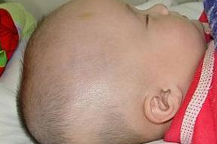 婴儿脑积水头颅增大图