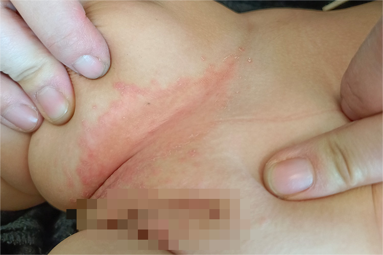 念珠菌性间擦疹症状图 念珠菌性间擦疹症状图