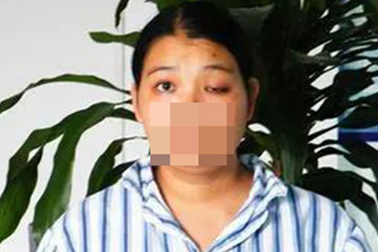 急性铊中毒眼睑症状图