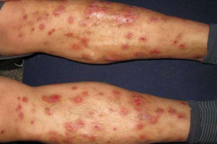 急性单纯性痒疹小腿症状图 急性单纯性痒疹小腿症状图