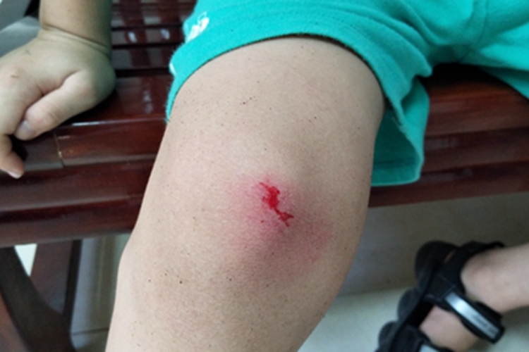 跌伤膝盖皮肤擦伤出血图