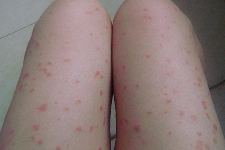 银屑病初期小红点图