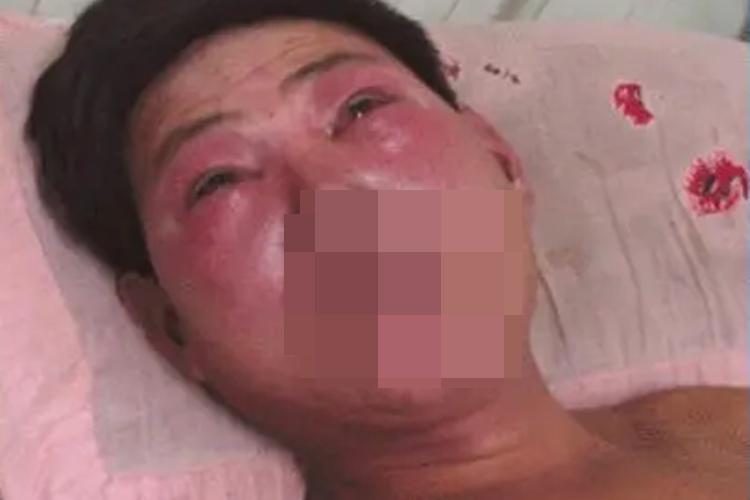 出血热颜面发红图