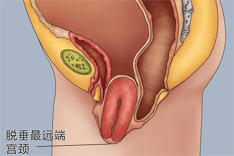 Ⅱ度子宫脱垂图 Ⅱ度子宫脱垂图