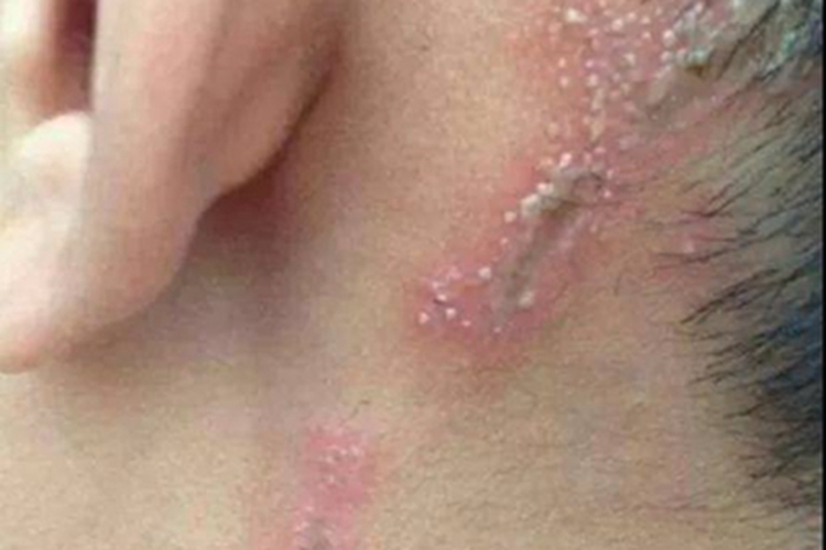 昆虫性皮炎耳后红斑图