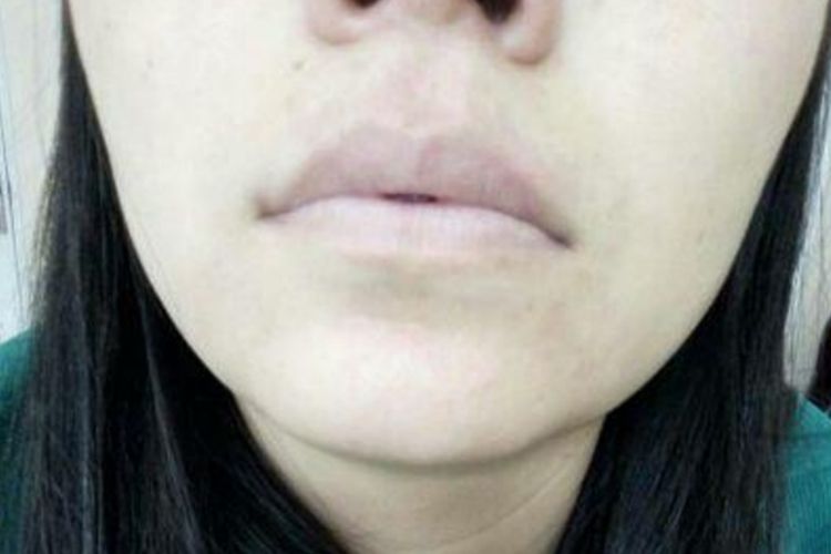 感染性休克面色苍白图 感染性休克面色苍白图